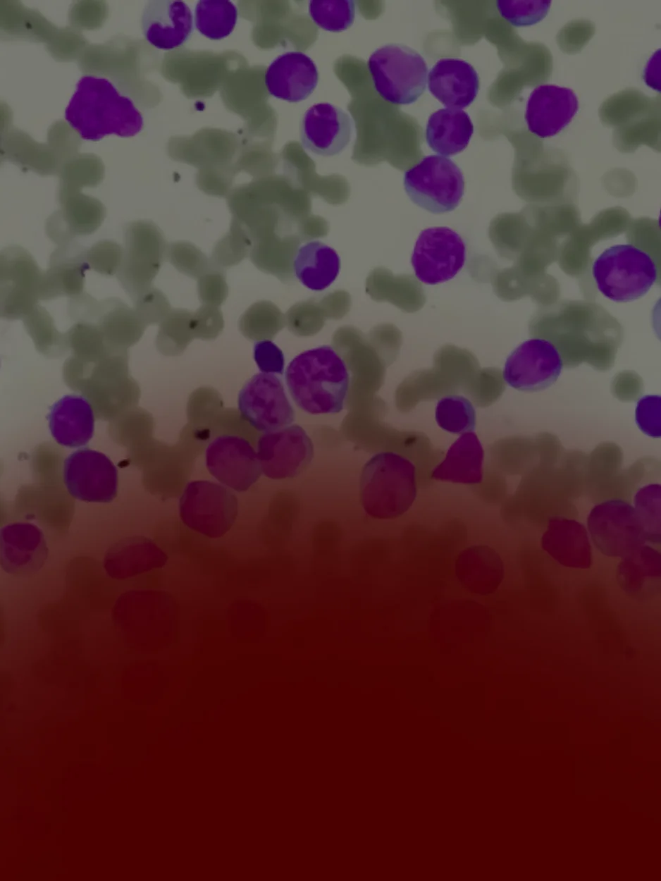 MIELOGRAMA - CBHL (CONGRESSO BRASILEIRO DE HEMATOLOGIA LABORATORIAL)