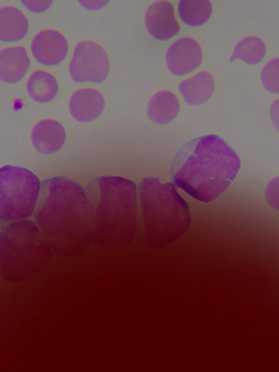 MORFOLOGIA - CBHL (CONGRESSO BRASILEIRO DE HEMATOLOGIA LABORATORIAL)
